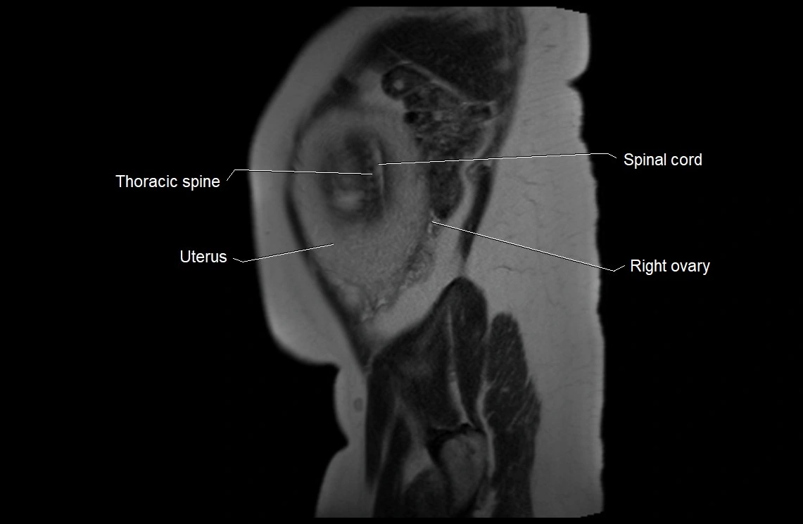 MRI fetal anatomy sagittal image 4.webp